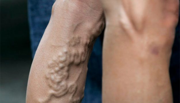 article-es-posible-correr-con-varices-59f6fb0485b4a